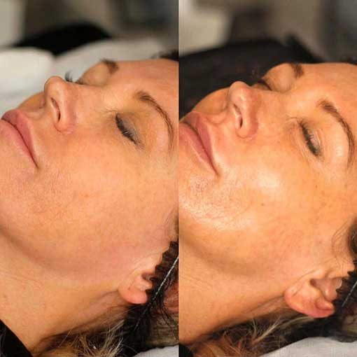 Dermaplaning in Saltash